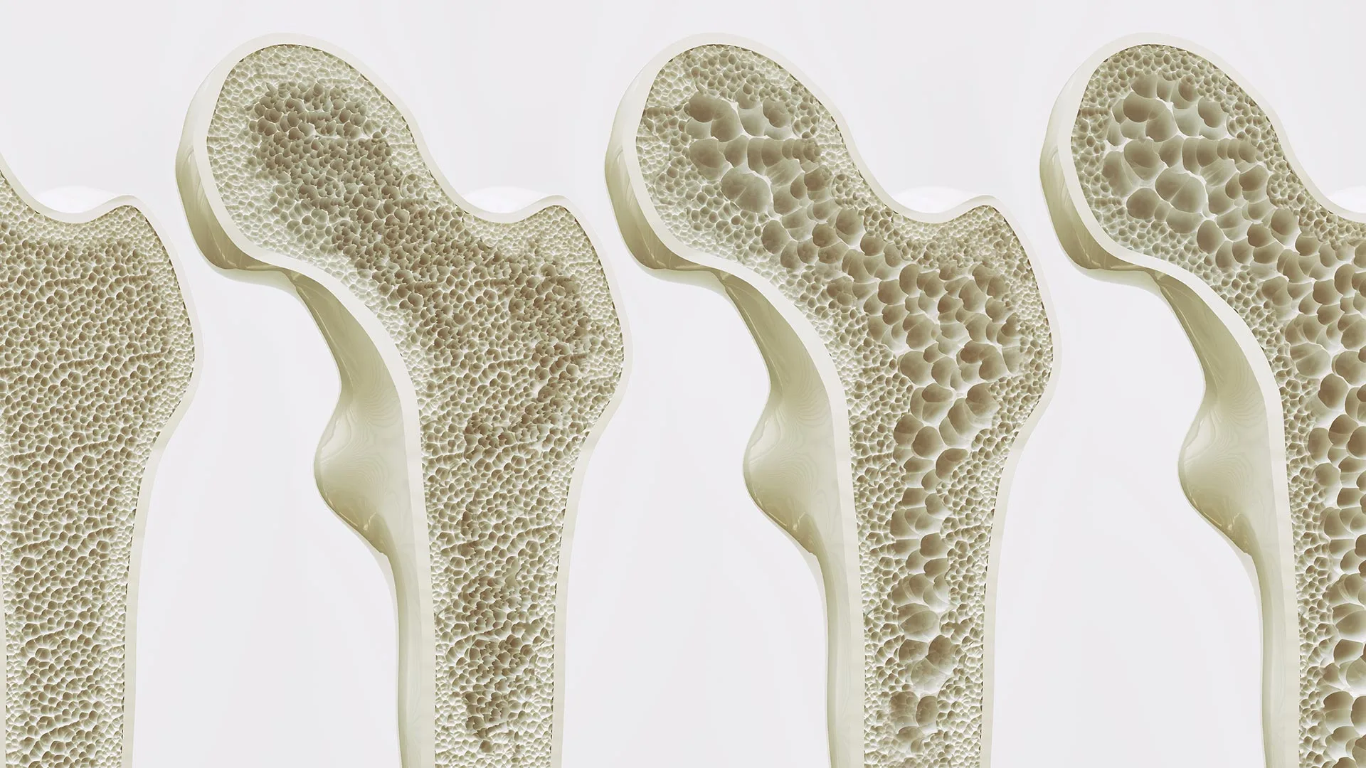 Experten Netzwerk Osteoporose Bild Osteoporose am Oberschenkelknochen