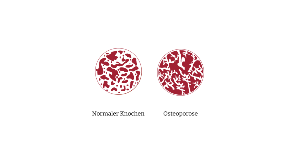 Experten Netzwerk Osteoporose Bild Osteoporose Knochenstruktur